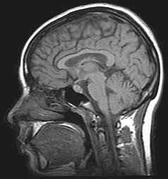 19-11MRI_brain.jpg