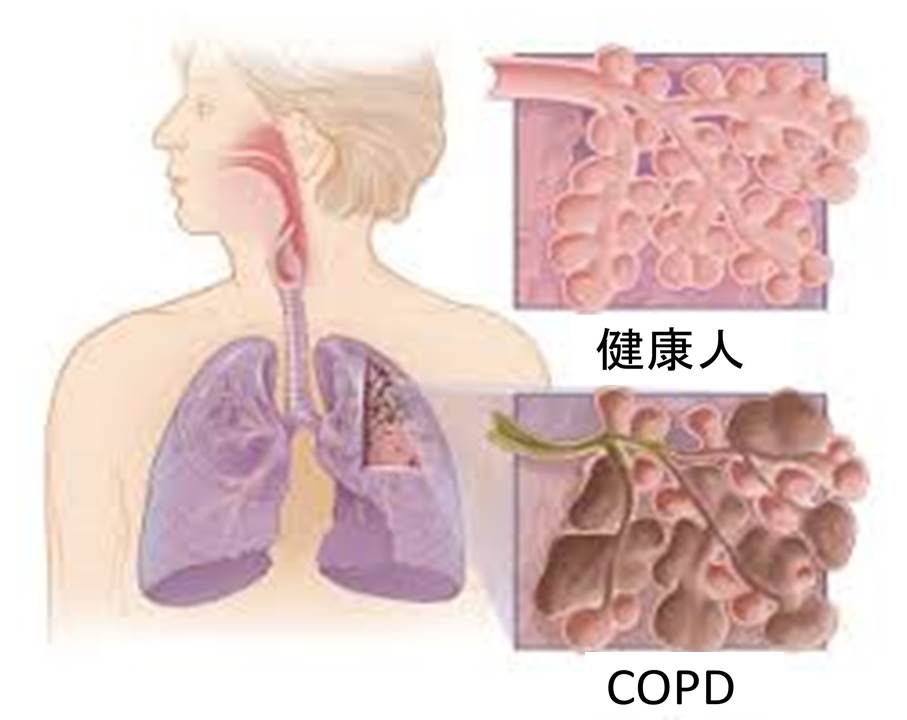 COPD.jpg