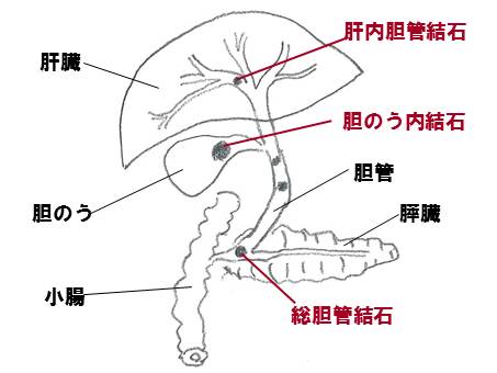 GallStone.jpg