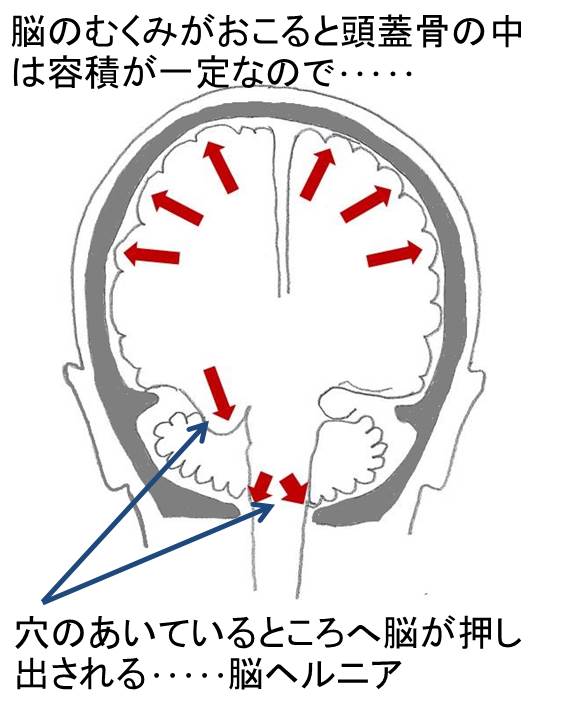 脳 ヘルニア と は